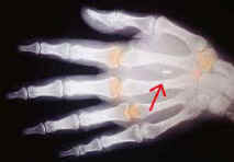 implanted.jpg (6986 octets)